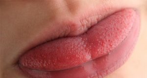 swollen-tongue
