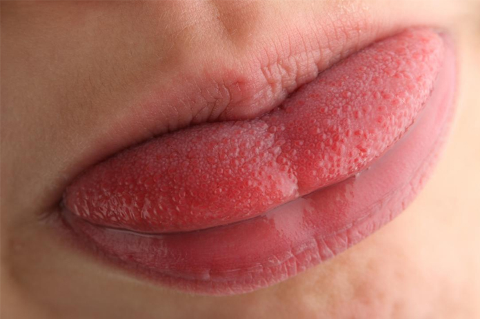 swollen-tongue