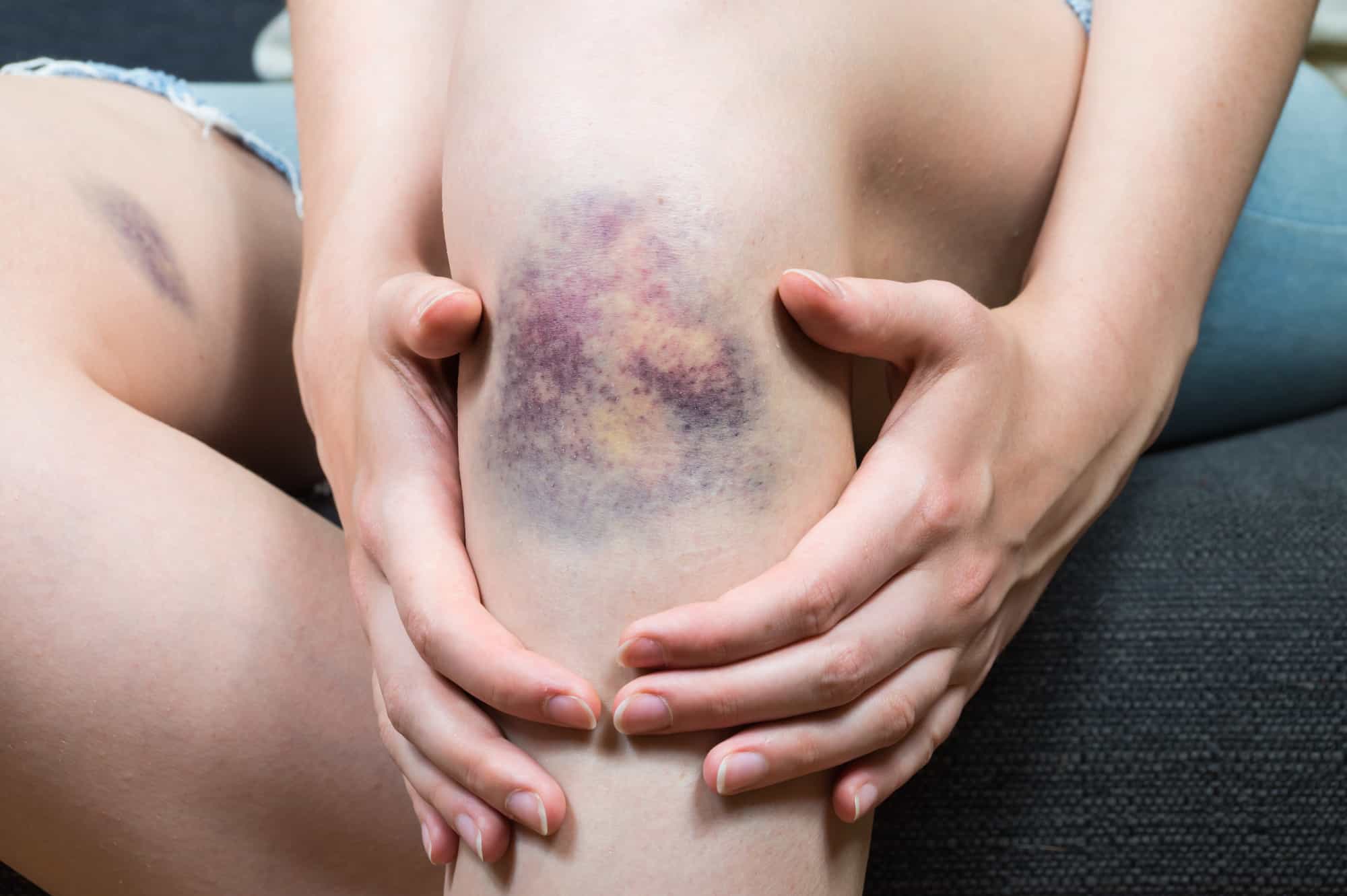 hematoma vs bruise